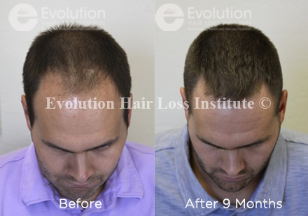 Justin mens hair loss before and after