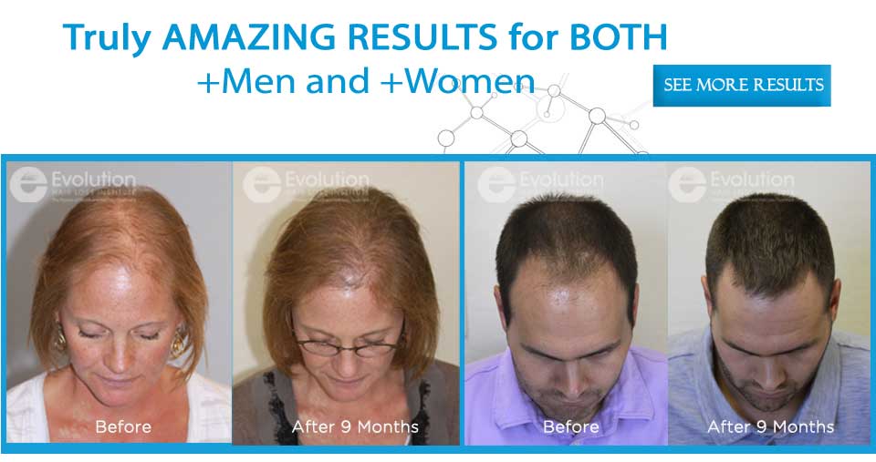 Hair Loss Before and After Treatment for Men and Women